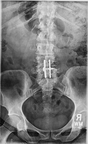 lumbar6c+mustafakhanmd.jpg