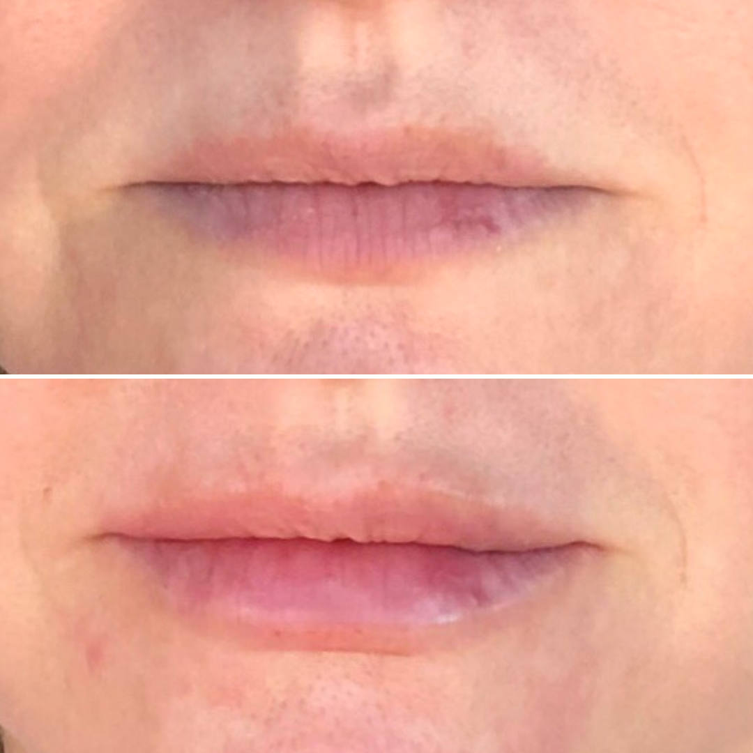 M. Hossle Lip Injections - Close Up.png