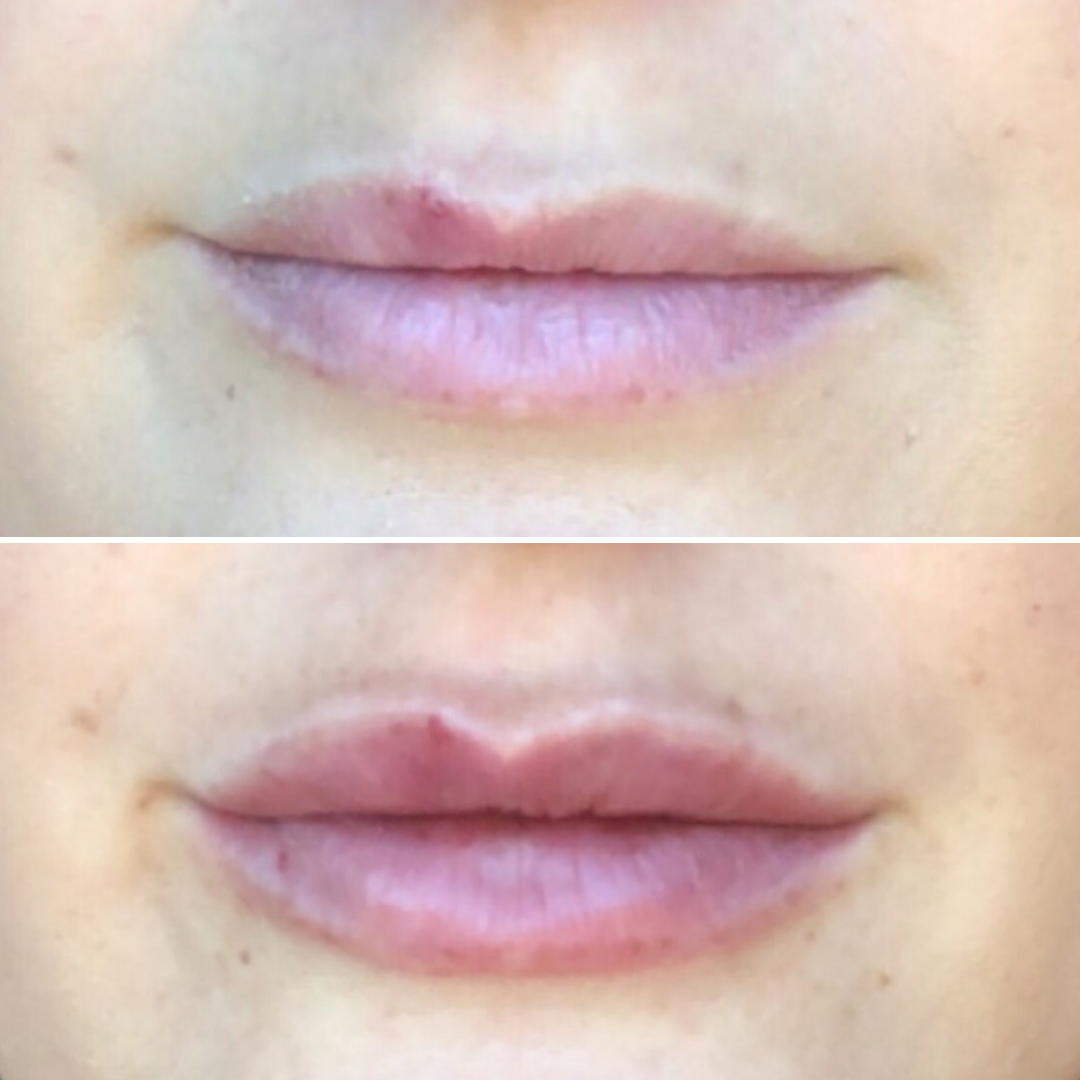 K. Stoeser Lip Injections - Close Up.png