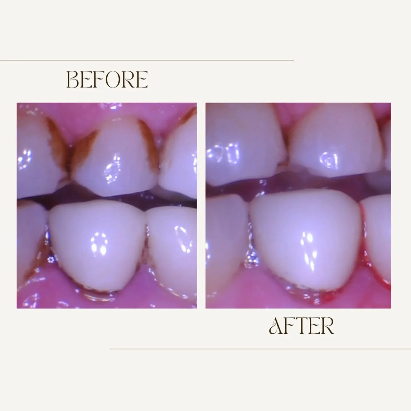 Are you due for a professional dental cleaning? Give us a call today to reserve your spot so we get you in your best dental heath! 🦷🪥
.
.
.
#siouxcenterdental 
#faithfamilyservice 
#generaldentist 
#dentalhygiene 
#beforeandafter