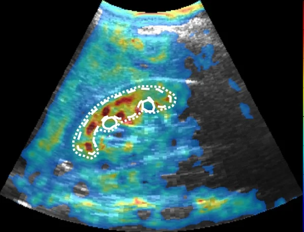 THED palpates kidney non invasively
