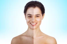 hyperpigmentation-before-and-after-treatment