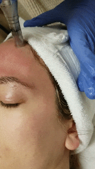 Microneedling-needling-service-demo