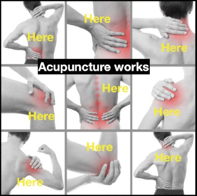 Acupuncture is extremely effective for acute and chronic pain management.