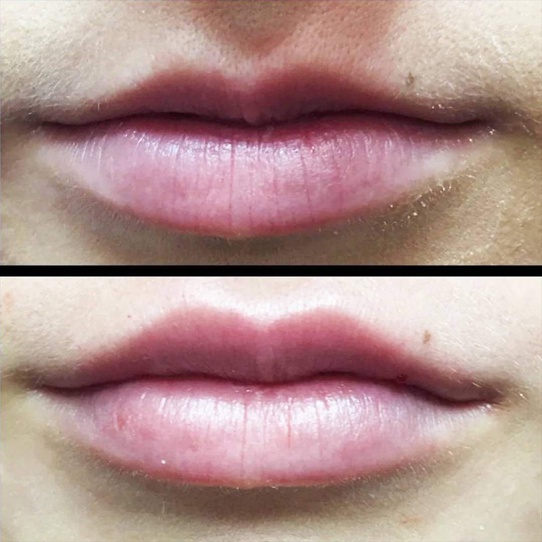 Treatment: Dermal Filler Treatment area: Lips