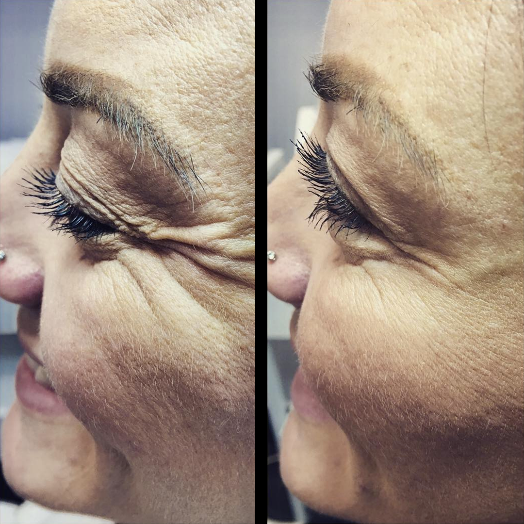 Treatment: Anti Wrinkle Injections Treatment area: Crow’s feet/eye area