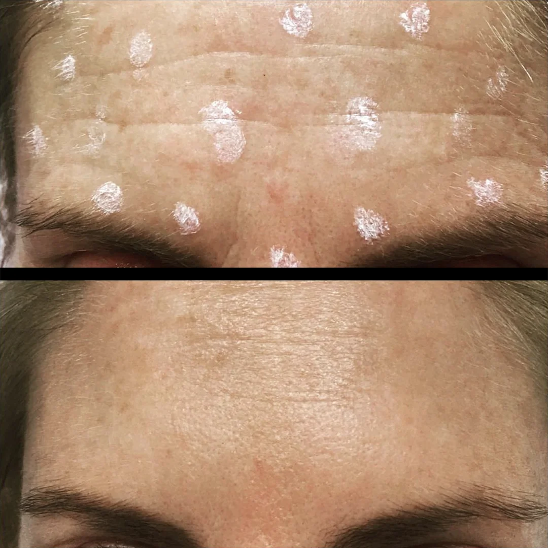Treatment: Anti Wrinkle Injections Treatment area: Forehead