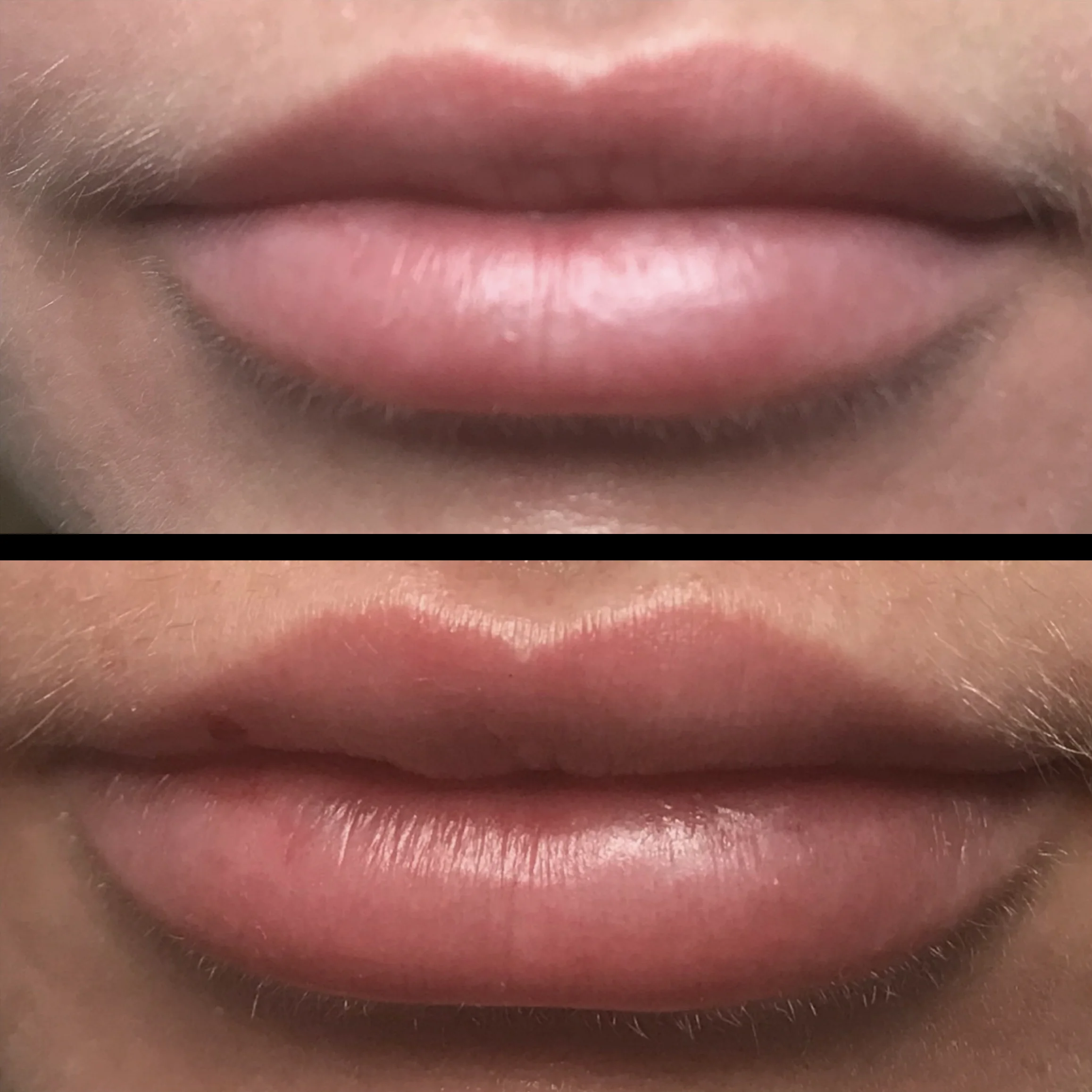 Treatment: Dermal Filler Treatment area: Lips