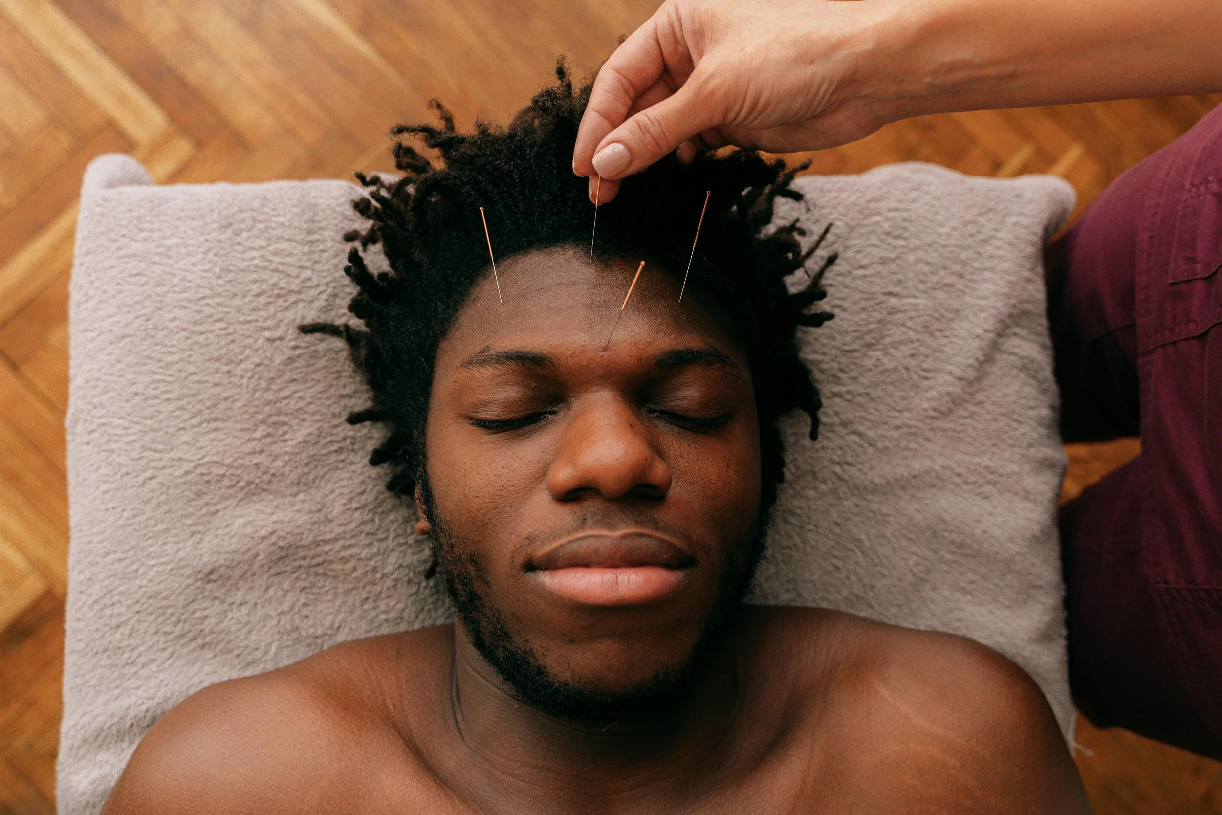Acupuncture treatment for migraines and chronic headaches.
