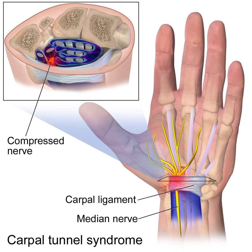 medical illustration indicating the pathogenesis of carpal tunnel syndrome