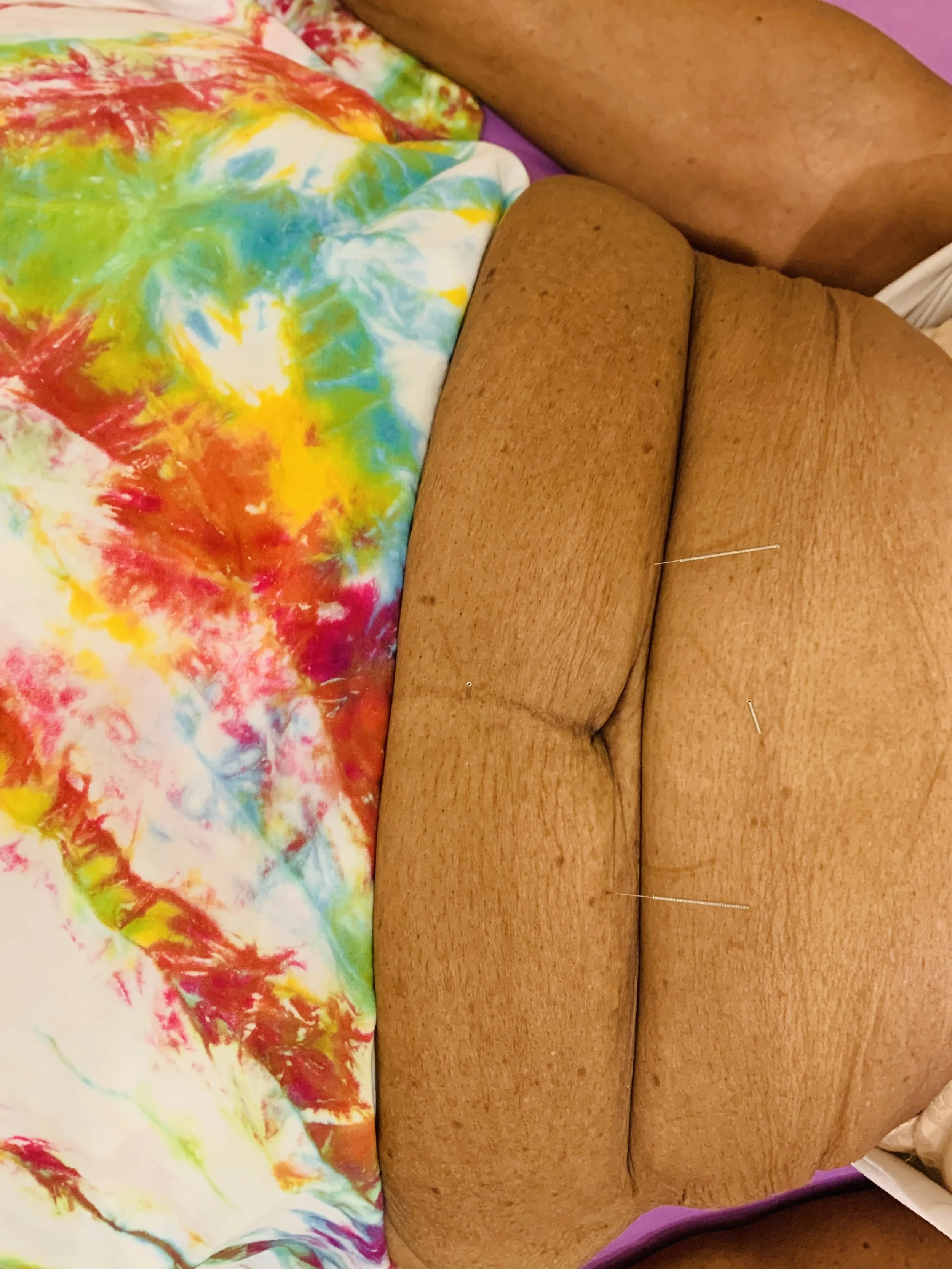 Acupuncture for women. 
