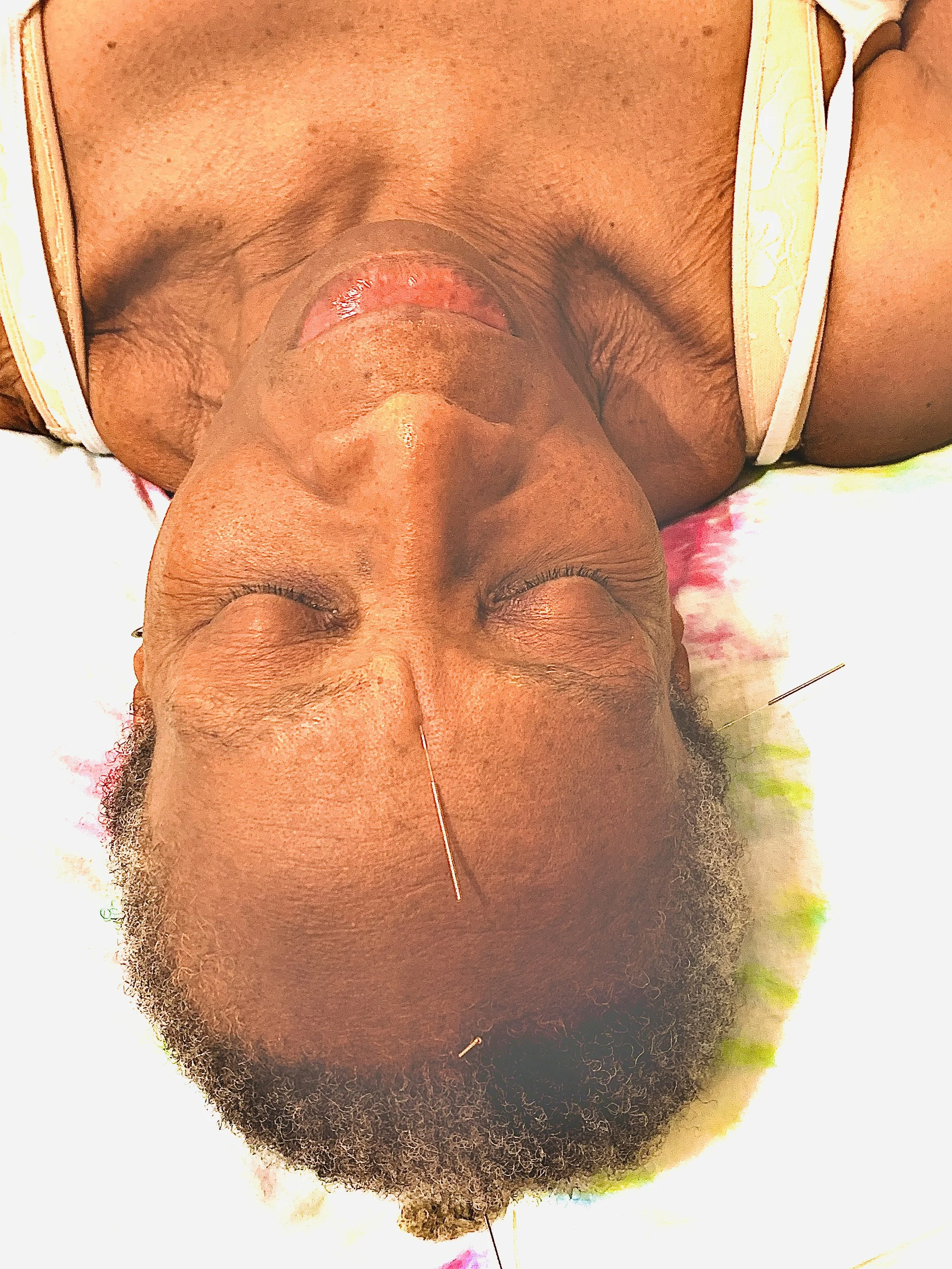 acupuncture for stress 