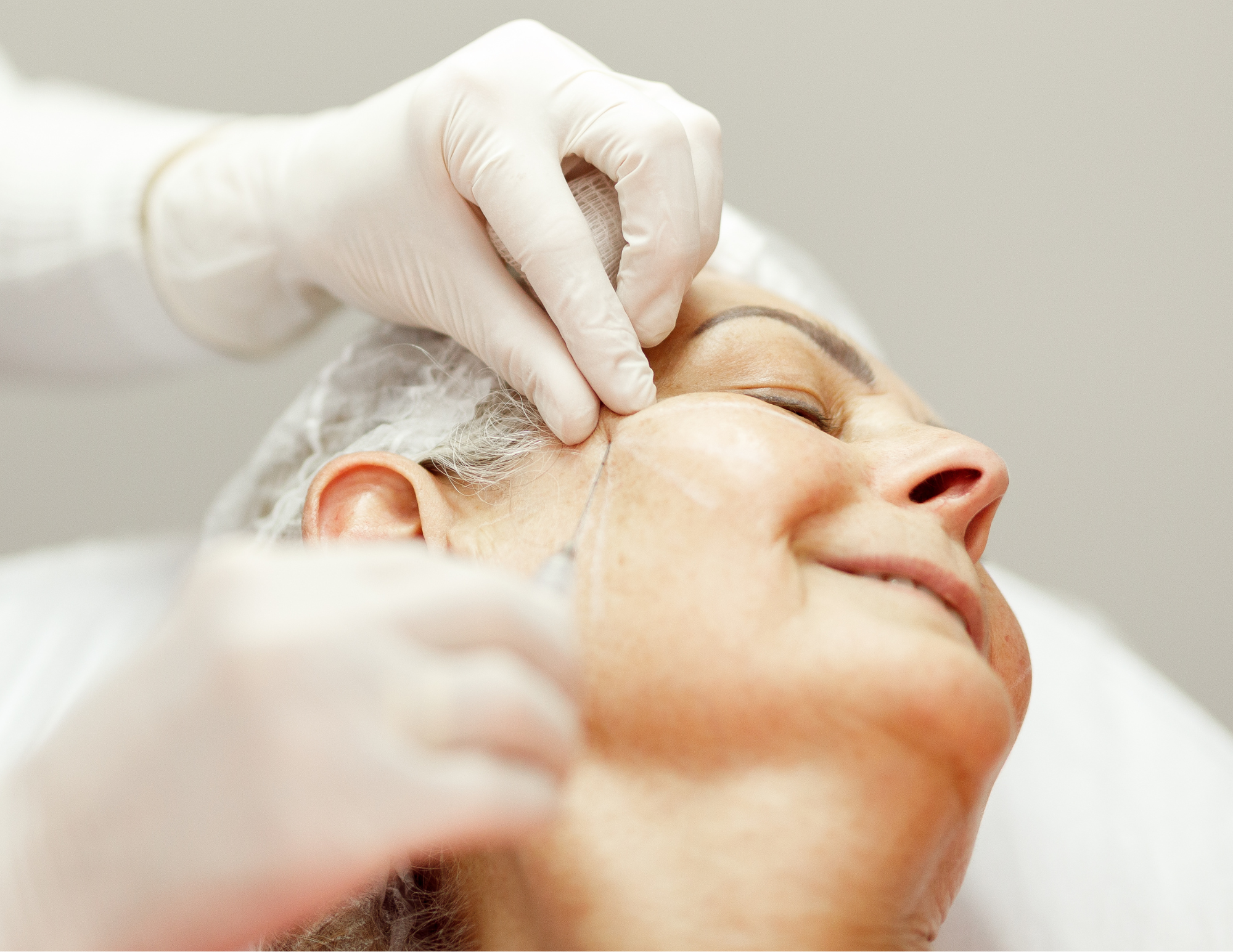 Biostimulator Sculptra Radiesse .png