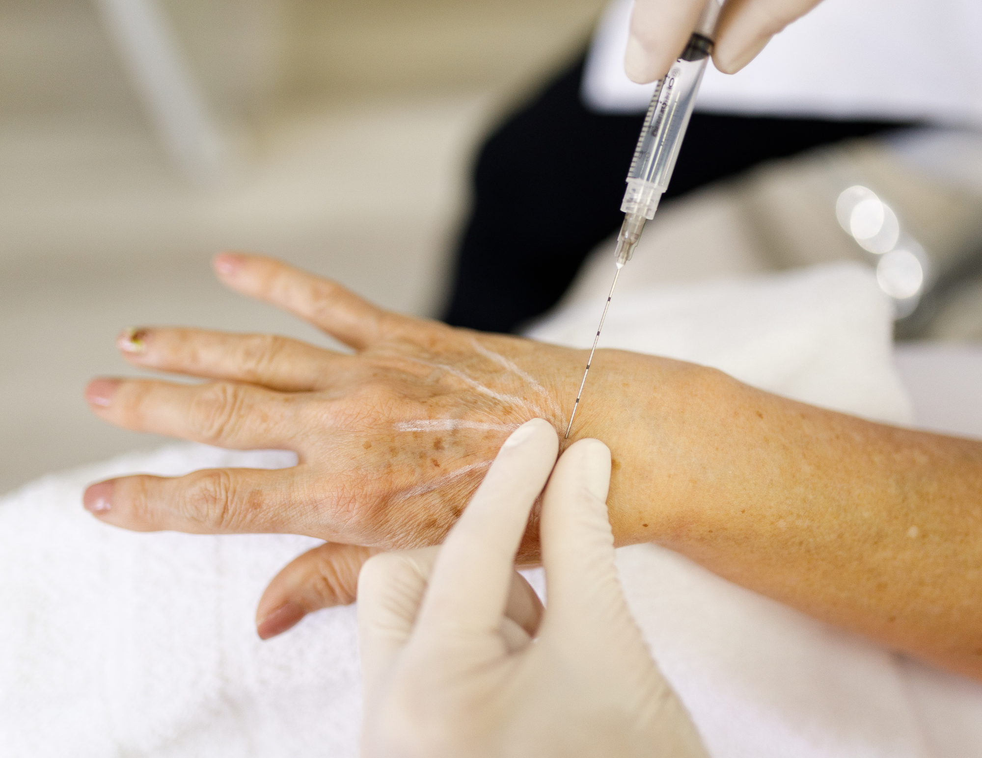 Biostimulator Sculptra Radiesse Hands.png