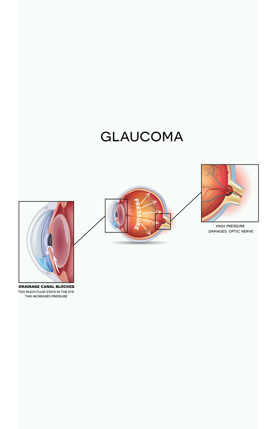 glaucoma visual.png