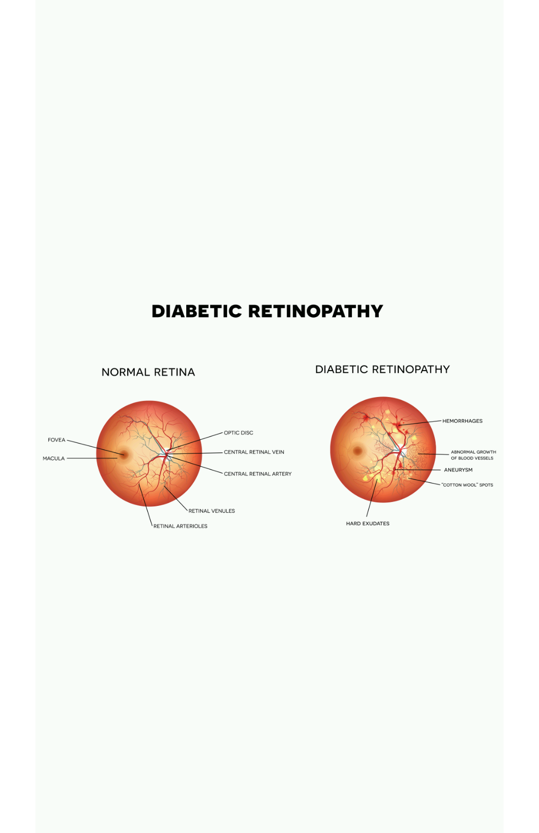 diabetic retinopathy compare.png