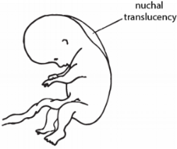 Nuchal translucency.png