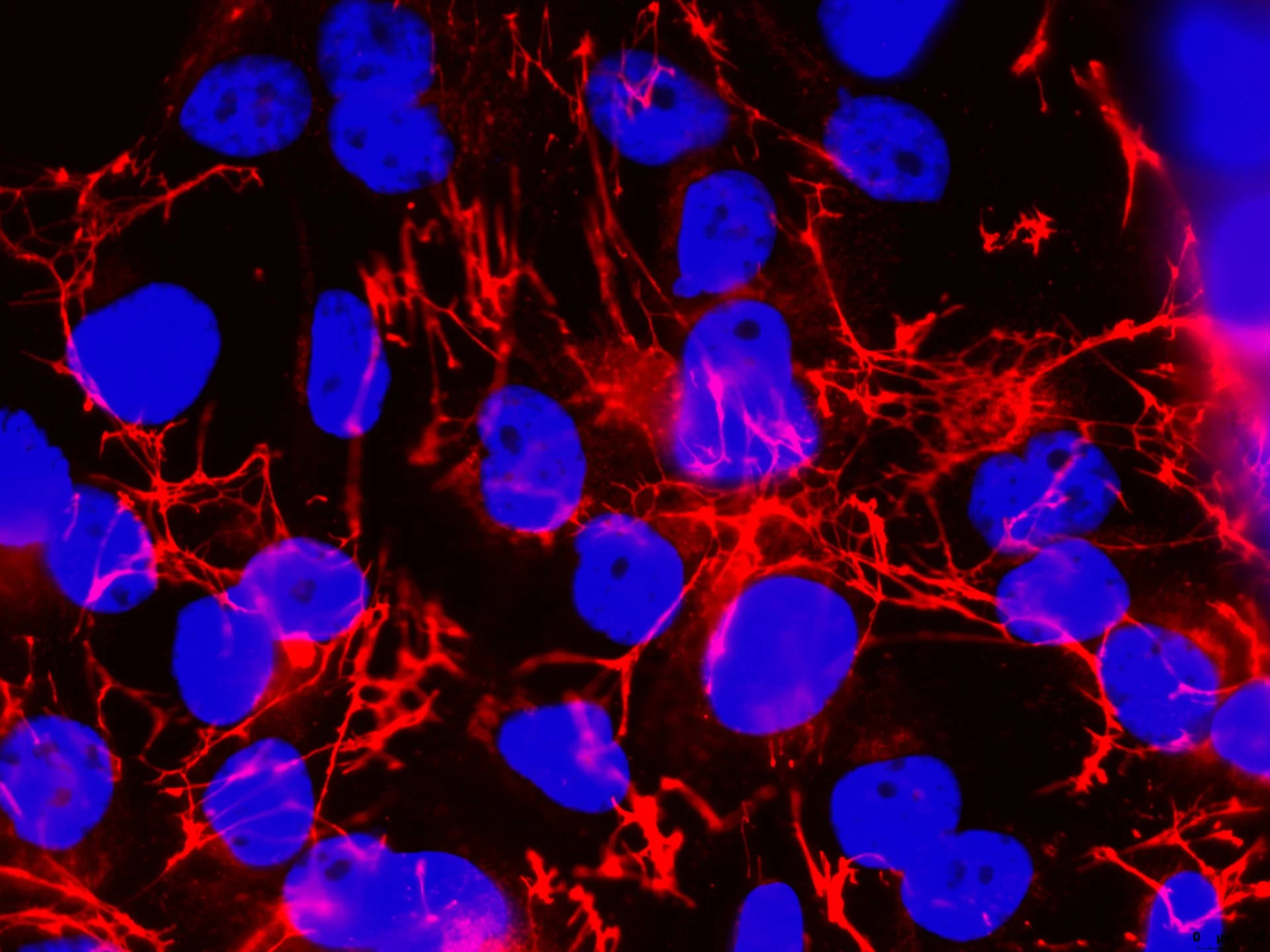 Caki-1 renal cancer cells immunostained for fibronectin (red) & nuclei (blue). Scale 5µm.
