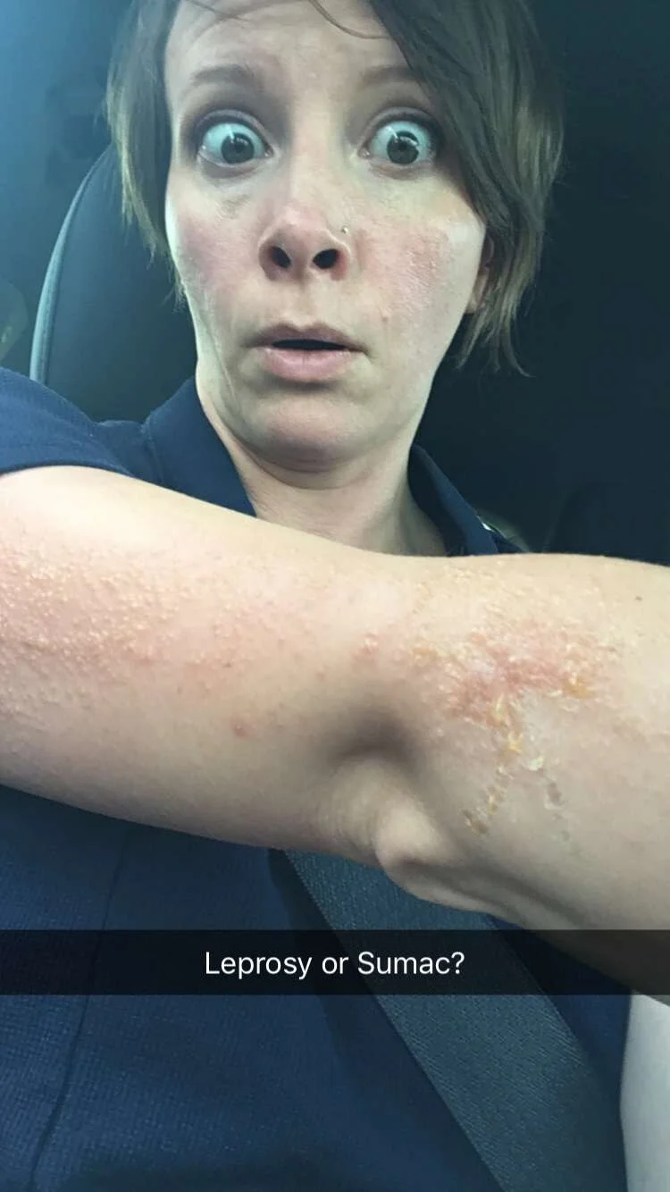 Poison Sumac On Face