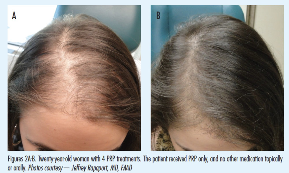Hair Restoration with PRP — Every You Aesthetics