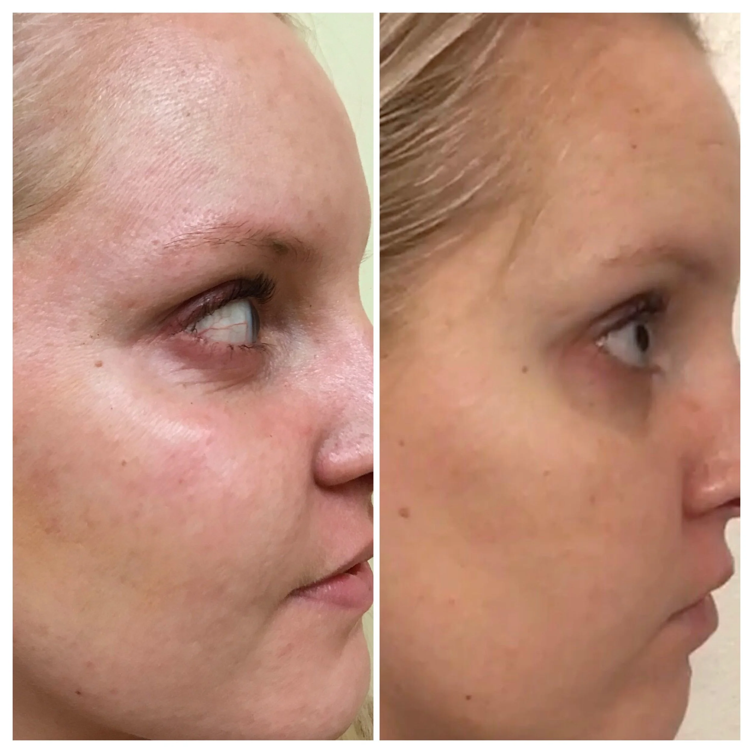 Microneedling with PRP, 2 weeks later