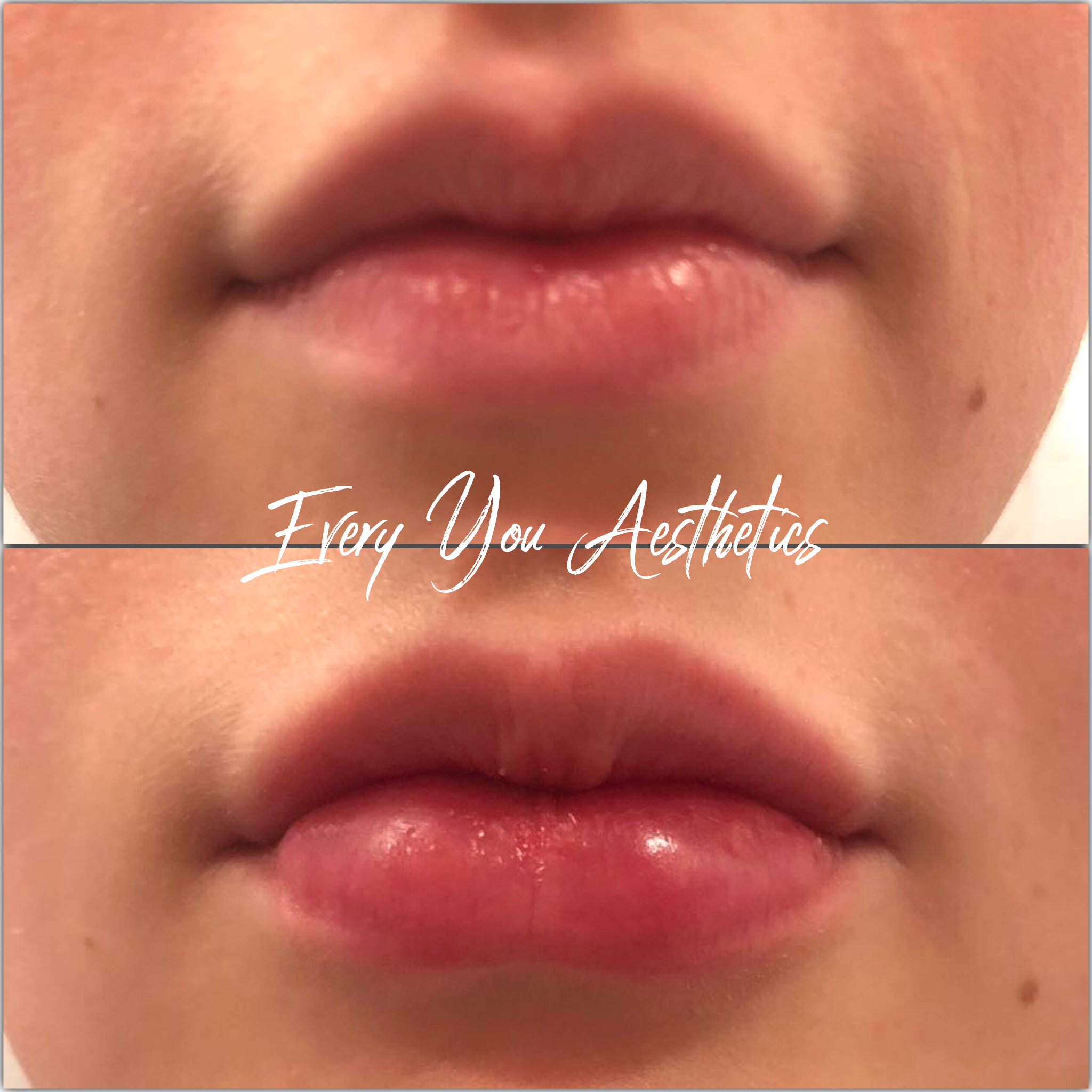 Lip Filler