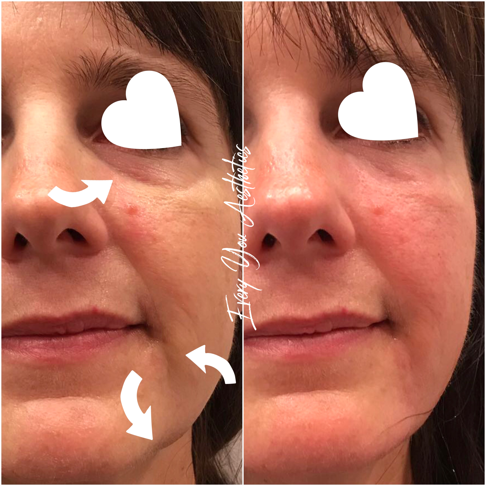 Dermal Filler