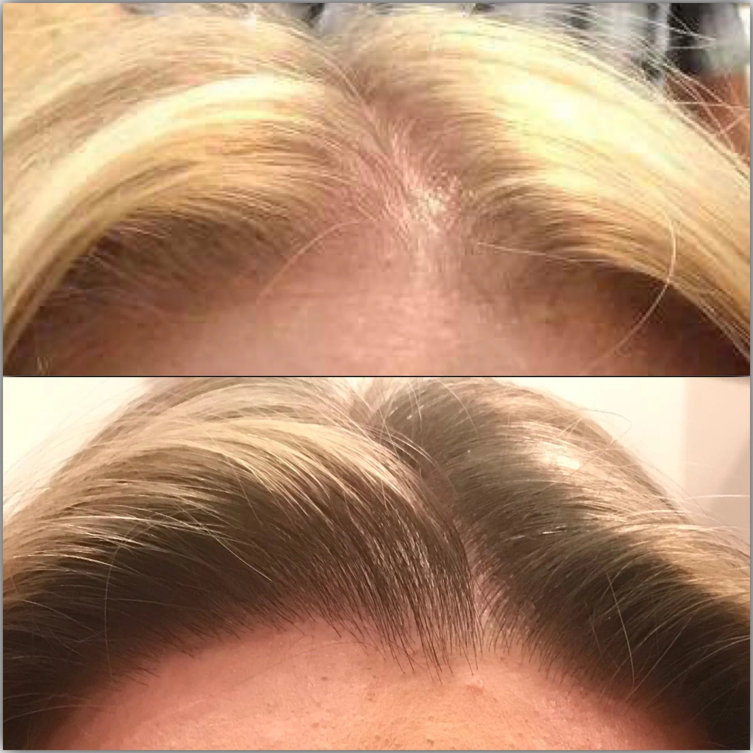 Hair Restoration