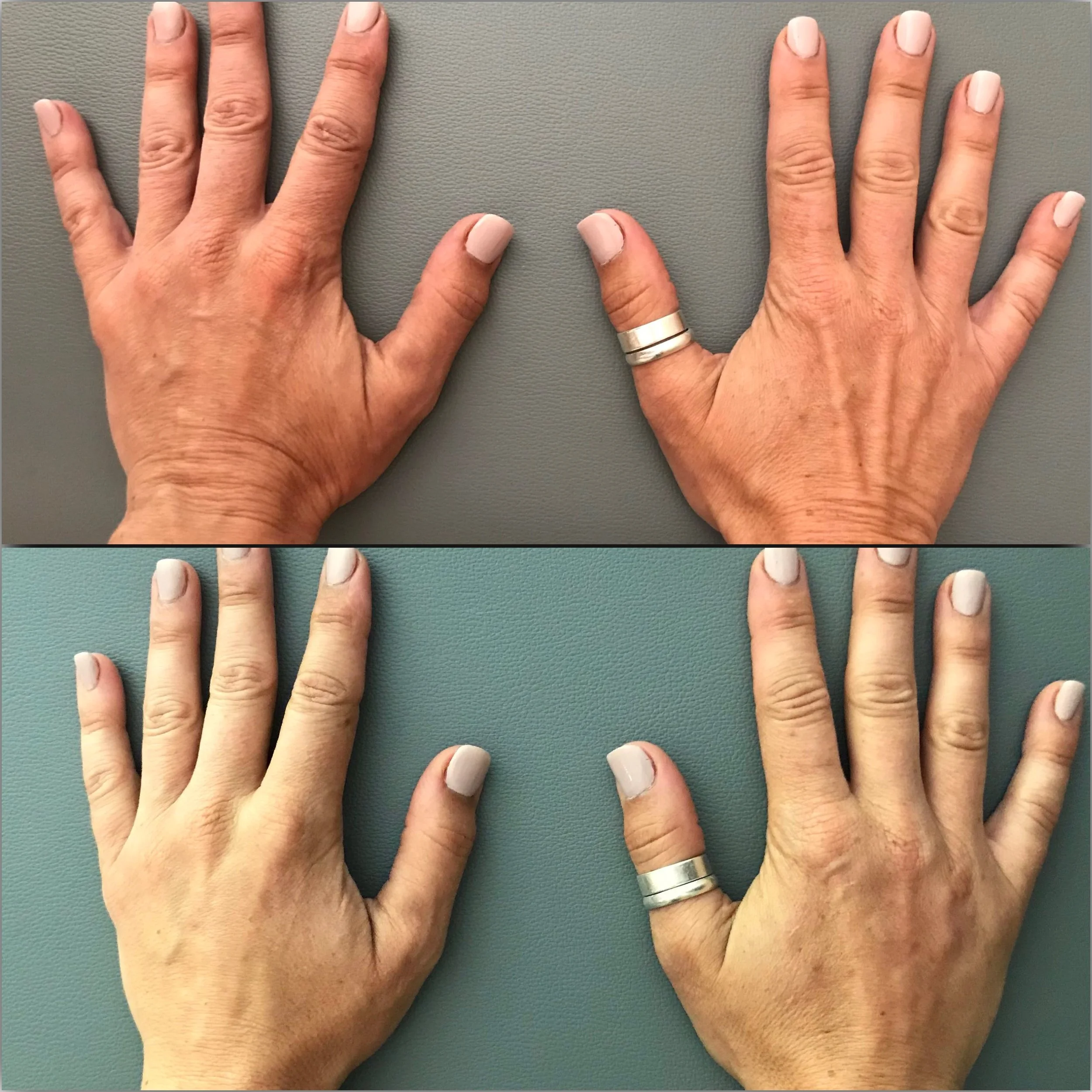 Dermal Filler