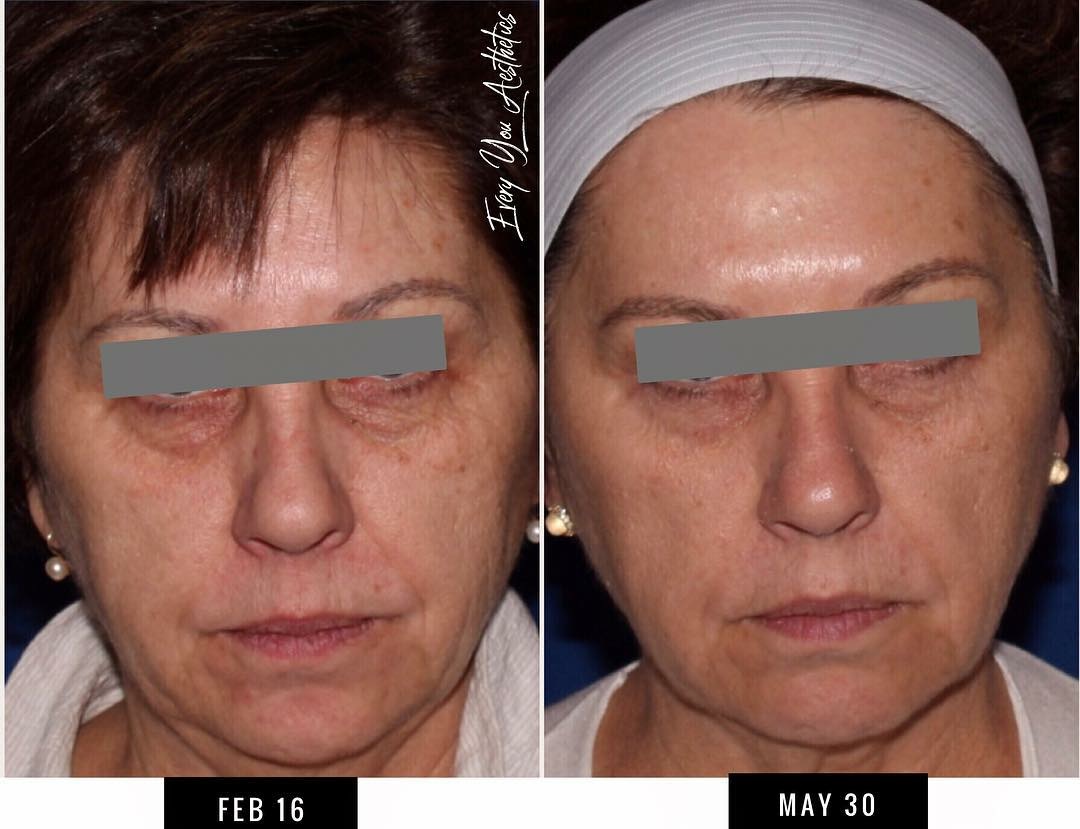 Microneedling with PRP