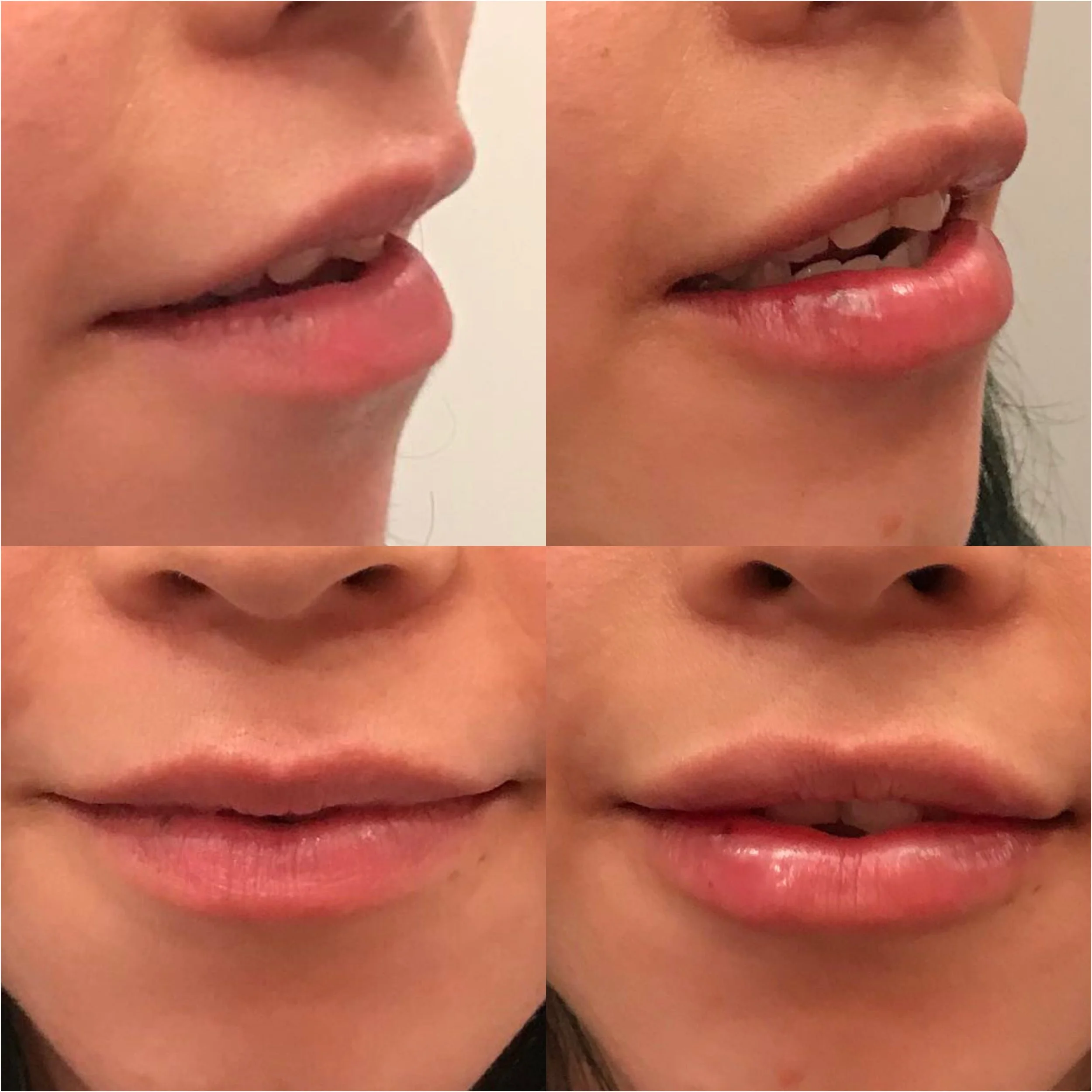 Lip Filler