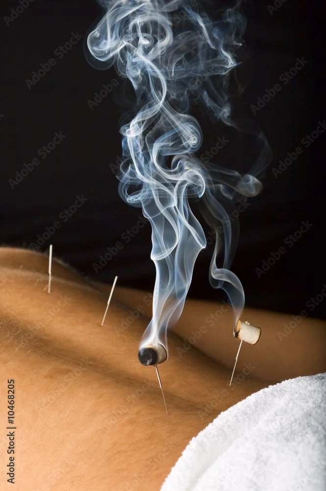 A person receives acupuncture treatment with several needles inserted into the skin of their back, and some burning herbal sticks creating smoke above the needles.