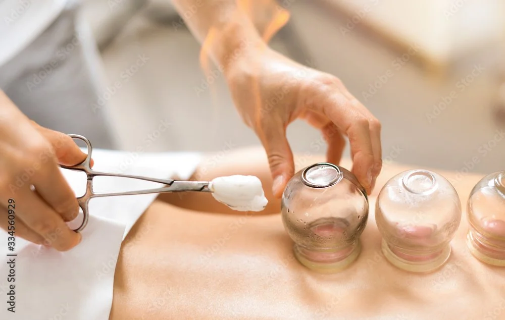 Person using metal tongs to place cotton balls or similar material into small glass cups on a person's back for cupping therapy.