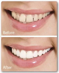 services-veneers-3.jpg