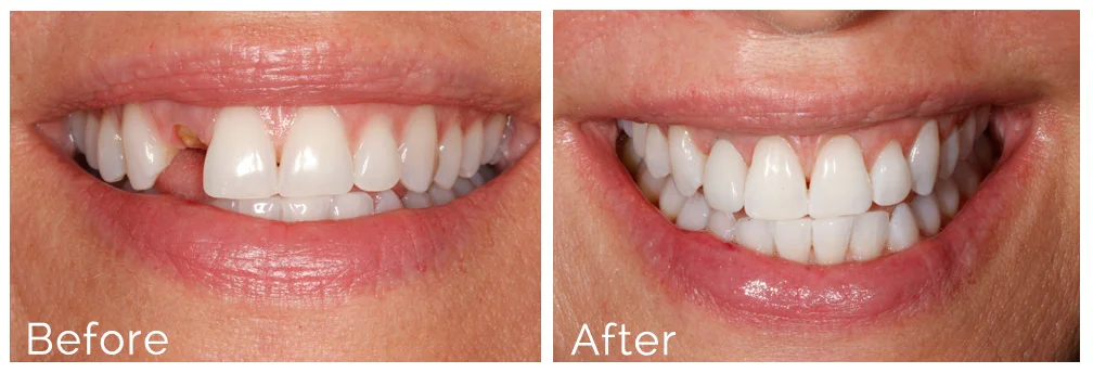 dental-implants-before-after-atlanta-ga.jpg