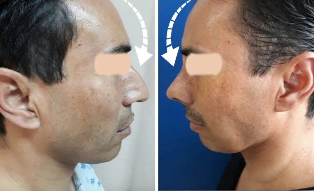 rhinoplastystpat.jpg