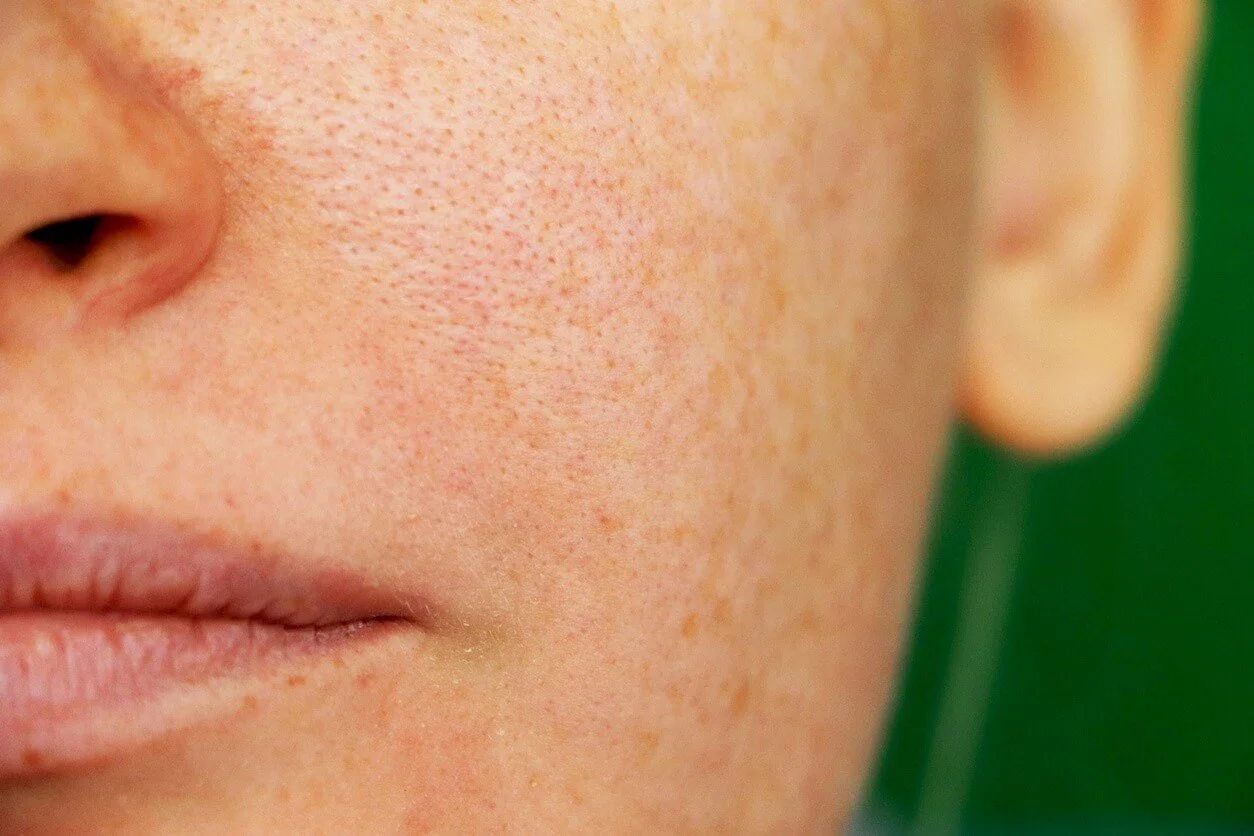 Open Pores