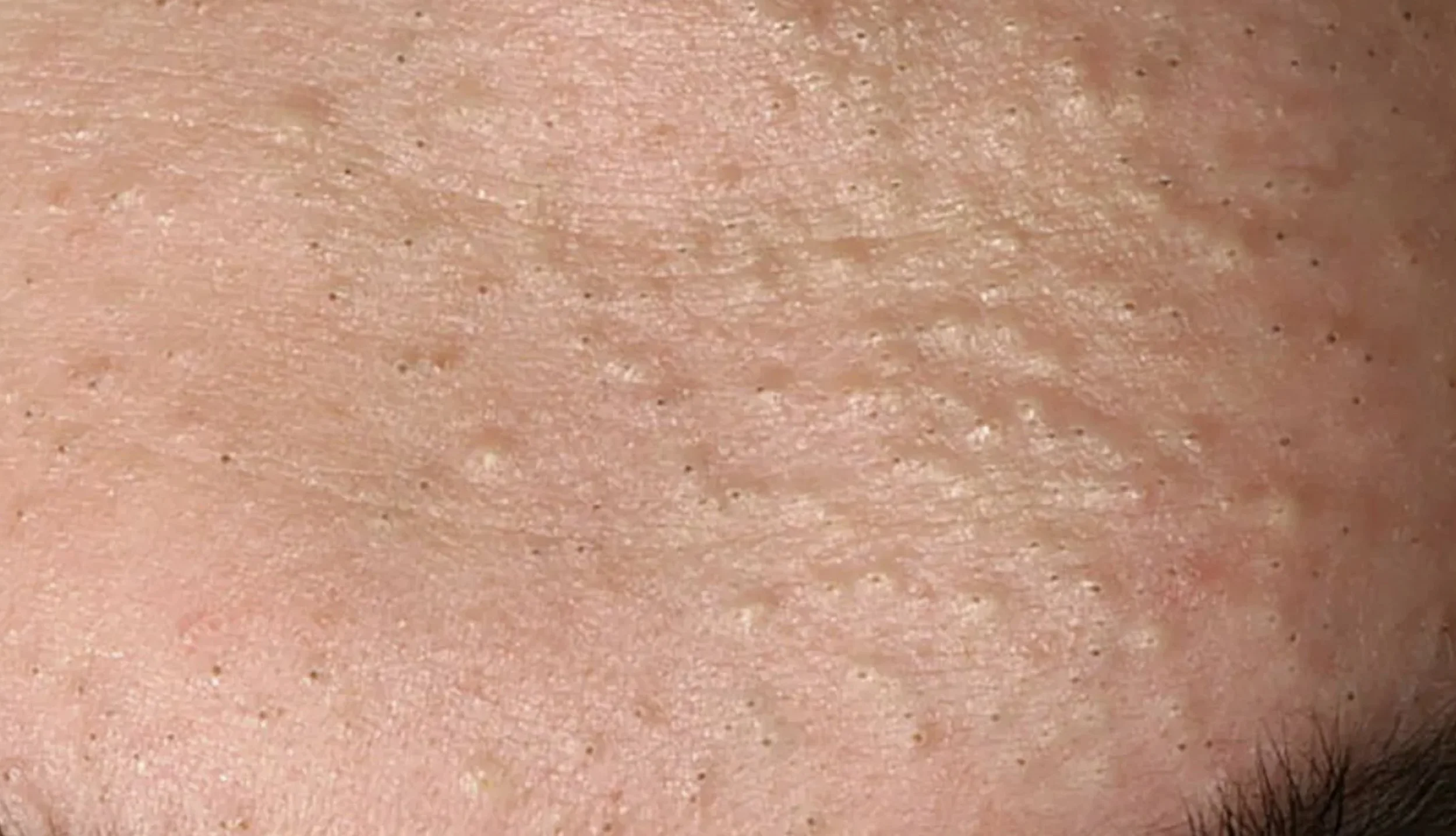 Acne (Adult)