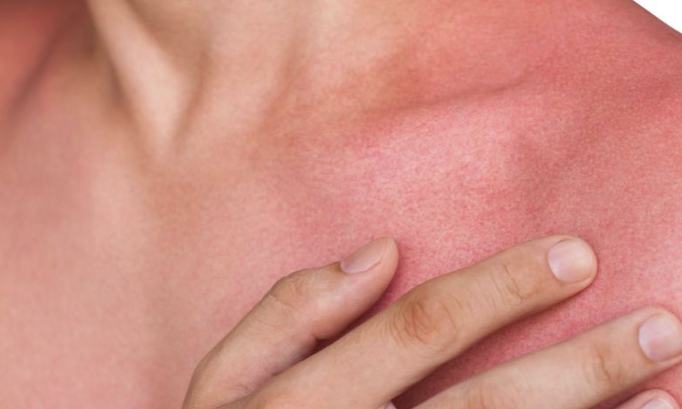 Eczema and Dermatitis 