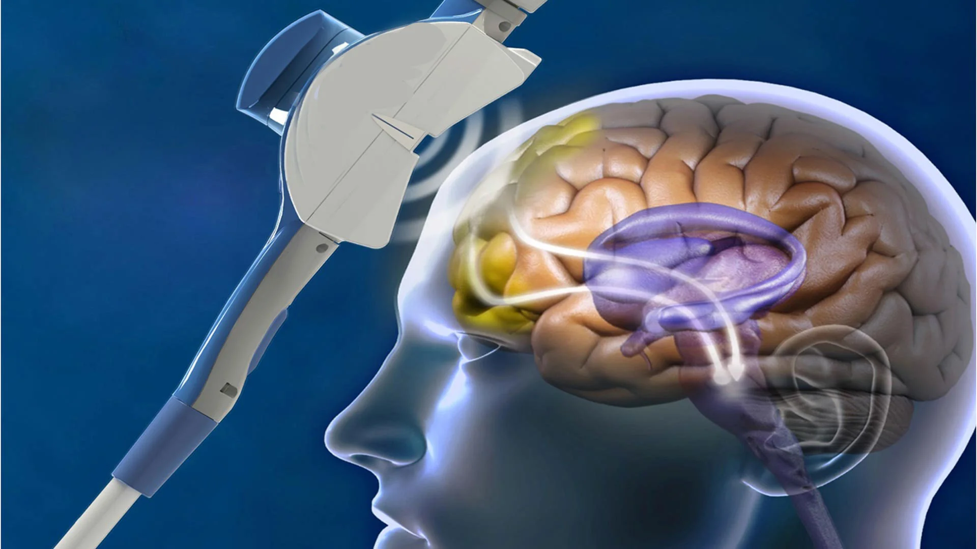 transcranial magnetic stimulation.jpg