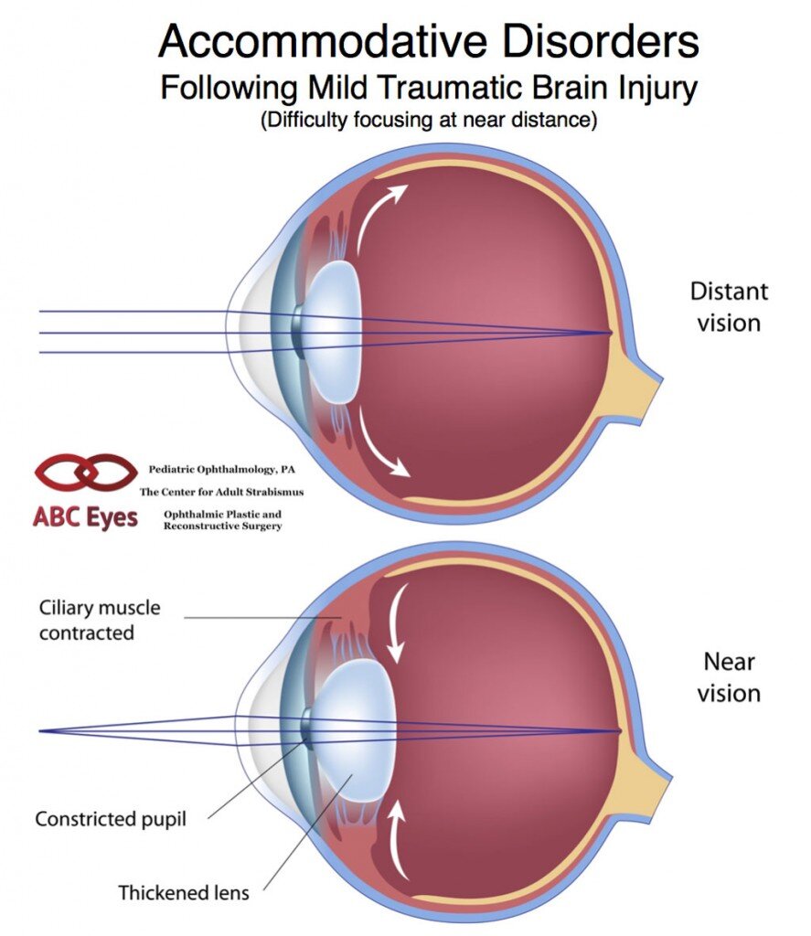 Vision therapy for concussions — Concussion Alliance