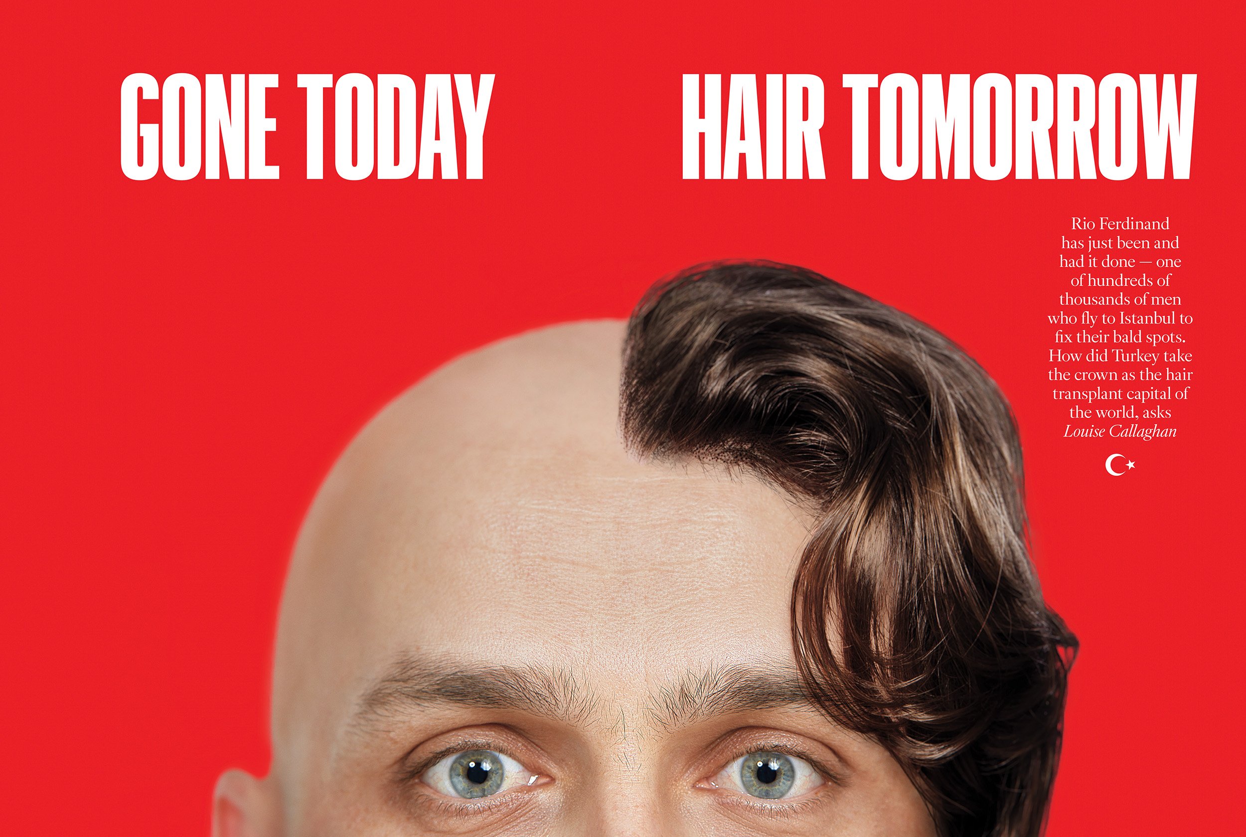 pcrowther_comm by SundayTimes for feature_Hair_transplant.jpg