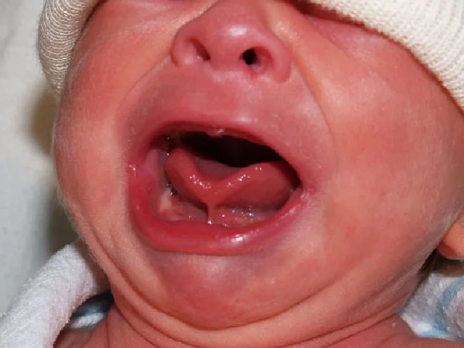 tongue tie.jpeg