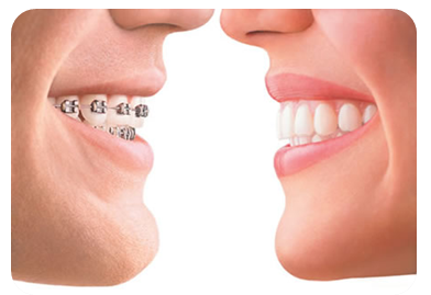 INVISALIGN VS METAL.png