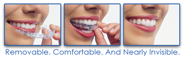 Invisalign Banner.png