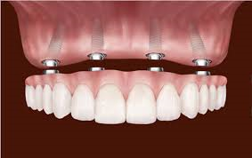 Dental Implant 2 (1).png