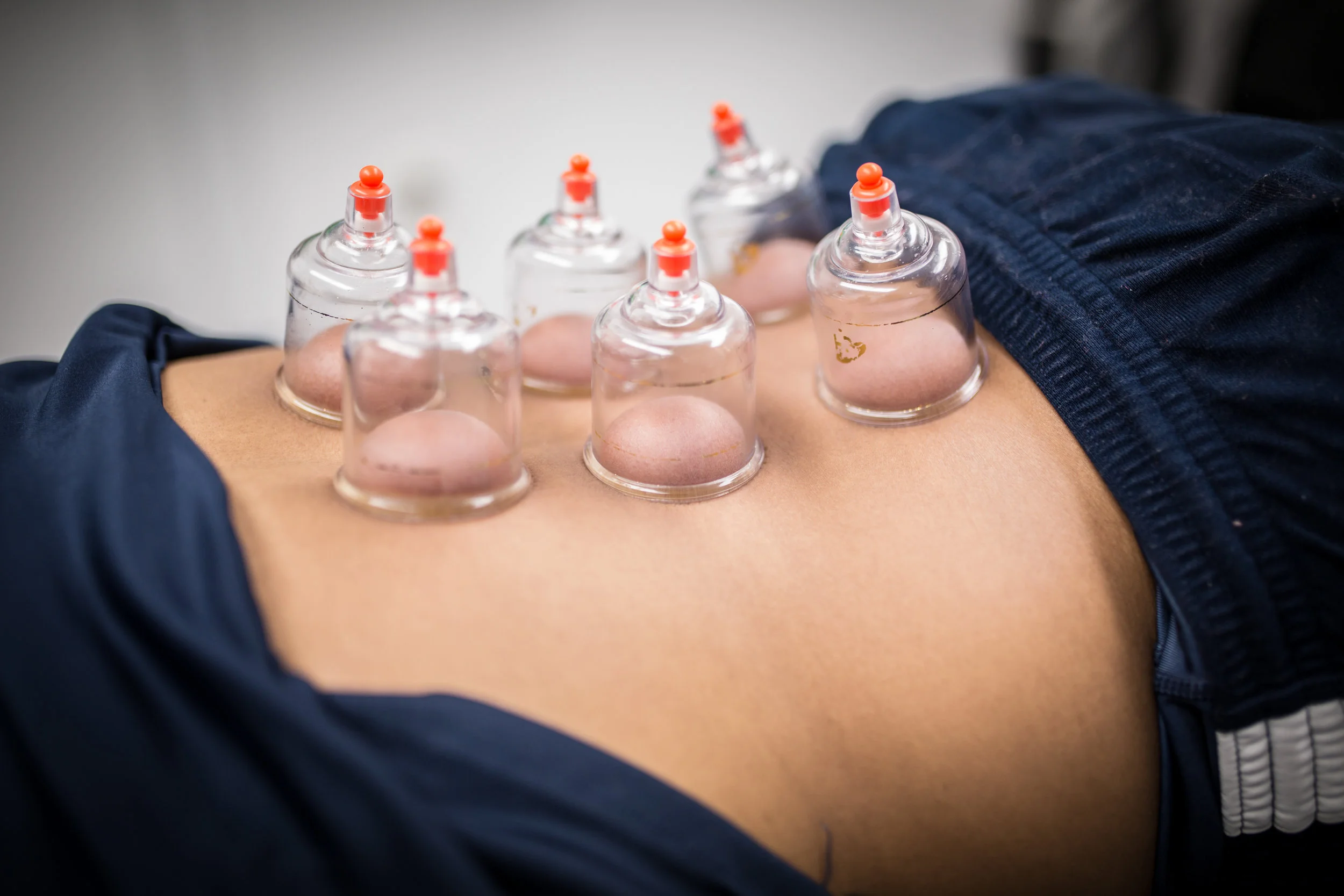 low back pain, cupping, cupping therapy, Baltimore sports physical therapy