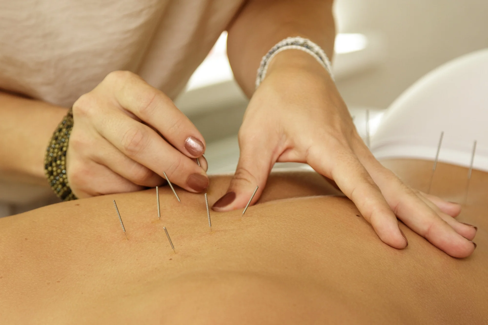 Acupuncture treatment with Heather Bree, Hillsborough NC