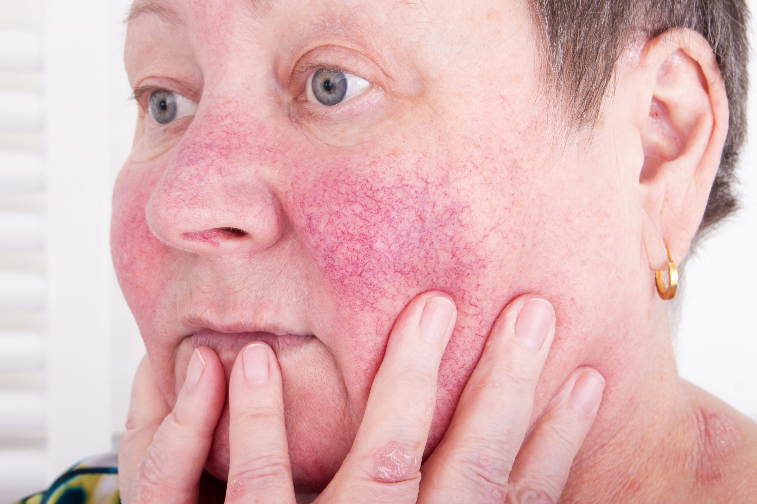 Rosacea - a brief explaination