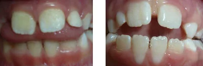 An open bite: front teeth do not touch each other when the child closes their mouth. This happens because during swallowing the tongue sits between the front teeth not allowing the jaws to come together.